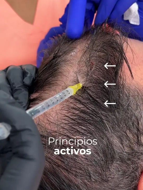 Mesoterapia con Dutasteride