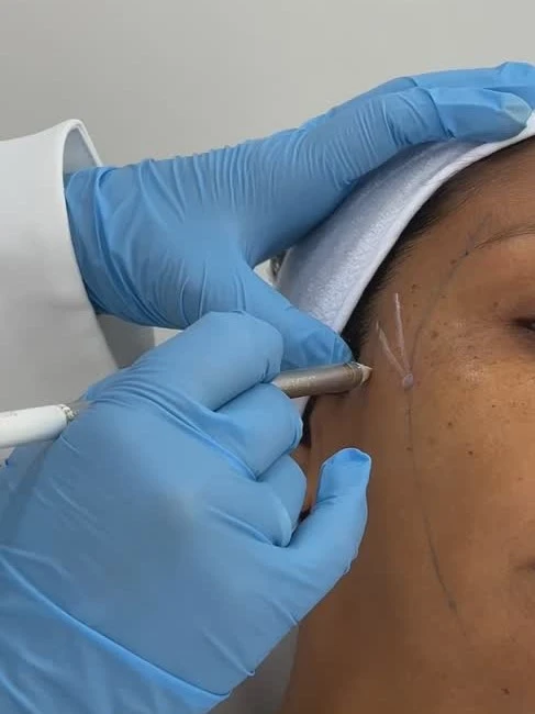 Aplicación de ácido